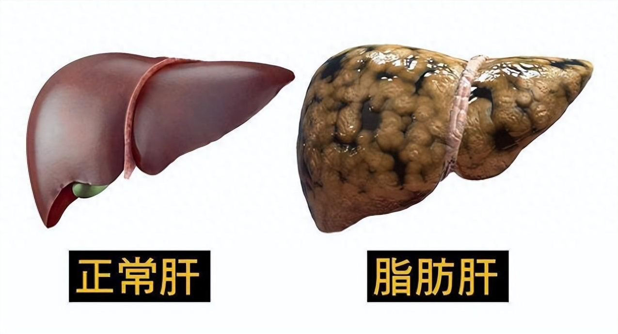 为什么人瘦了，肝却更“胖”了？