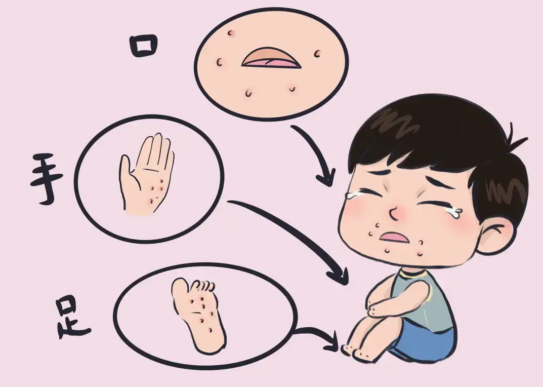 高发季来了！手足口病防护全攻略